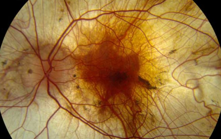 Spotlight on Choroideremia: A Rare Inherited Eye Disorder 