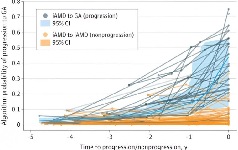 Study: Novel Algorithm Predicts AMD Progression with 94% Accuracy