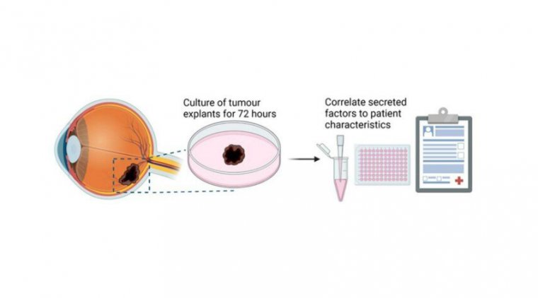 Study Uncovers Potential Biomarker and Candidate Drug for Uveal Melanoma