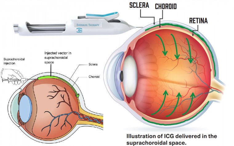Suprachoroidal Delivery System 