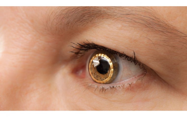 Telescopic Contact Lenses: Innovative Solutions for Vision Impairment
