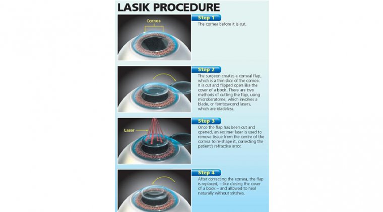 The Basics of Excimer Laser