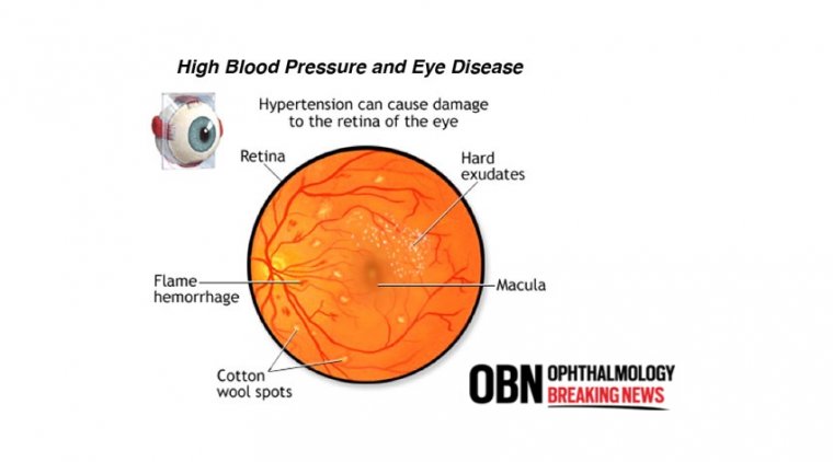 The Connection Between Blood Pressure and Glaucoma