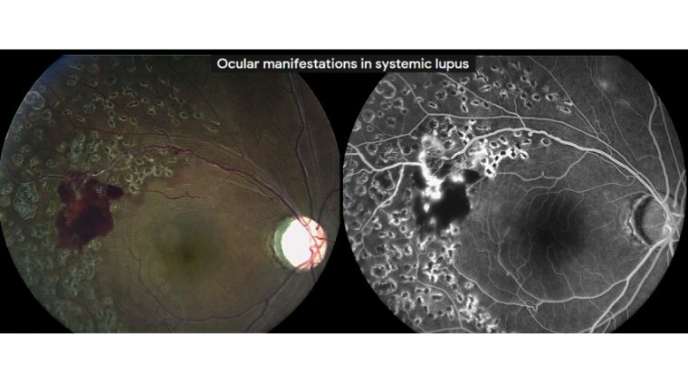 The Connection Between Lupus and Macular Degeneration