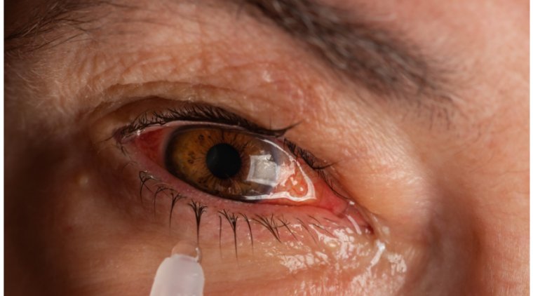 Why Conjunctivitis Is Called Madras Eye