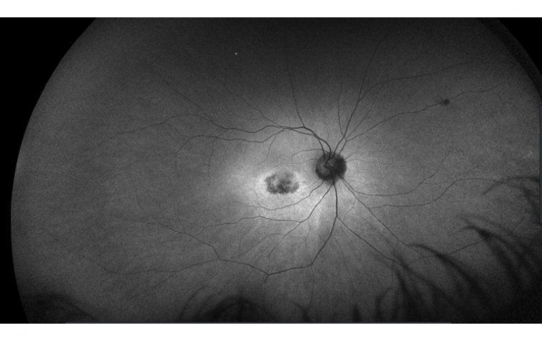 The Dangers of Plaquenil: Understanding Retinal Toxicity