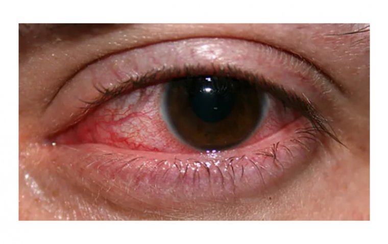 The Eye Infection That Can Steal Your Sight: Keratitis Explained