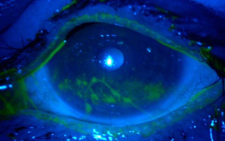 The Eye Pain You Can't Ignore: A Guide to Corneal Abrasions