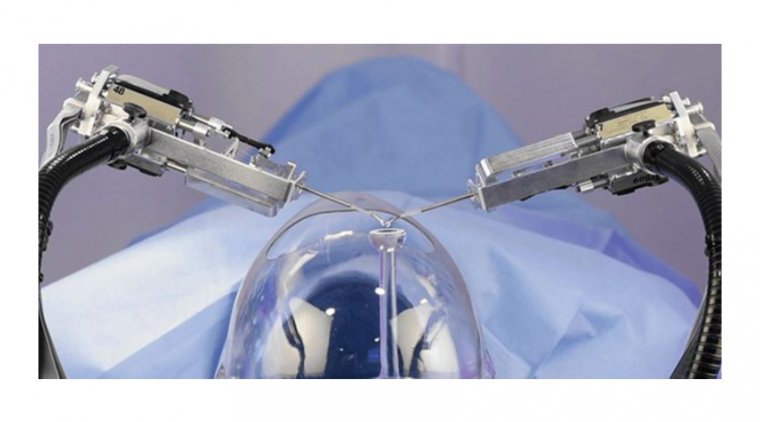 The Human Hand vs. The Robotic Arm: The Debate over Cataract Surgery