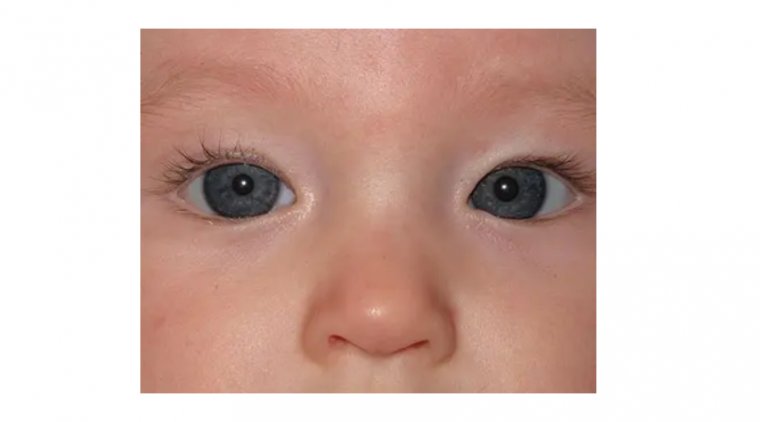 The Illusion of Crossed Eyes: Understanding Pseudostrabismus