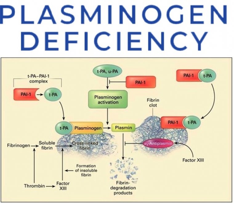 The Link Between Congenital Plasminogen Deficiency &  Blood Ties