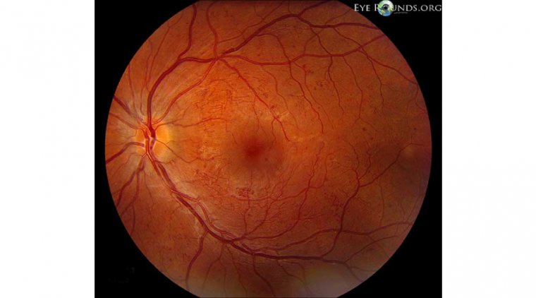 The Link Between Diabetes and Intraretinal Microvascular Abnormalities