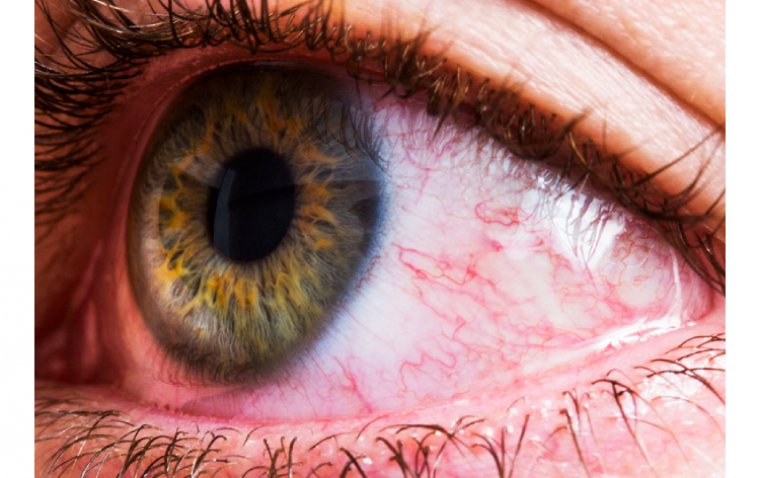 The Most Common Eye Allergies and Treatments