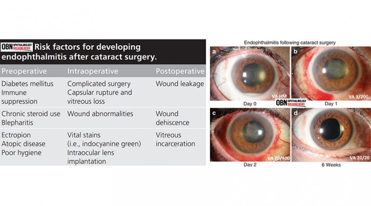 The Risk of Endophthalmitis Increase after Cataract Surgery