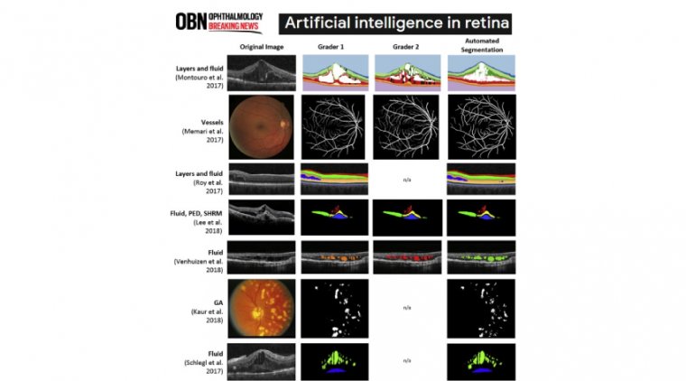The Role of Artificial Intelligence & Deep Learning In Retinal Disease