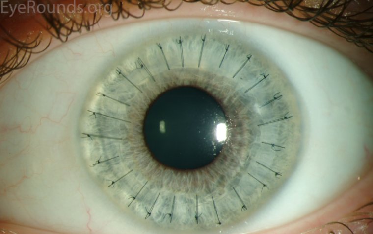 The Role of Penetrating Keratoplasty in Corneal Disorder Solutions 