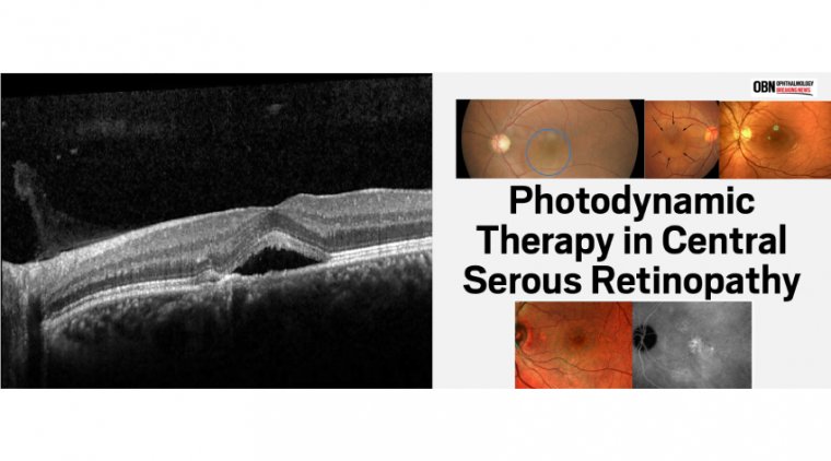 The Role of Photodynamic Therapy in Central Serous Retinopathy 