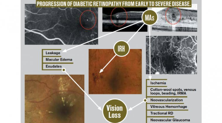 The Treatment Strategies for Refractory Diabetic Macular Edema