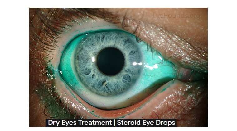 The Use of Steroids for Treatment of Dry Eye Syndrome