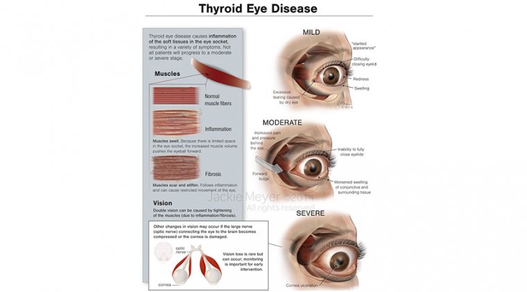 Thyroid Eye Disease