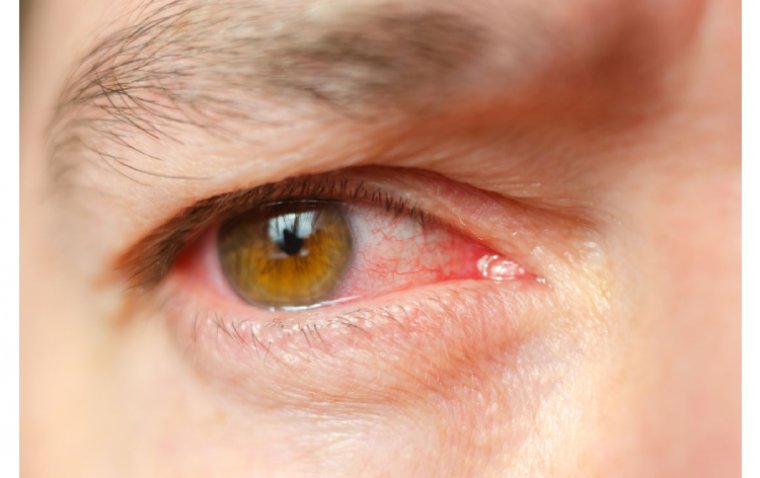 Top 5 Natural Remedies for Eye Infections