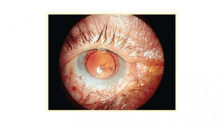 Toxic Anterior Segment Syndrome (TASS) in Ophthalmology