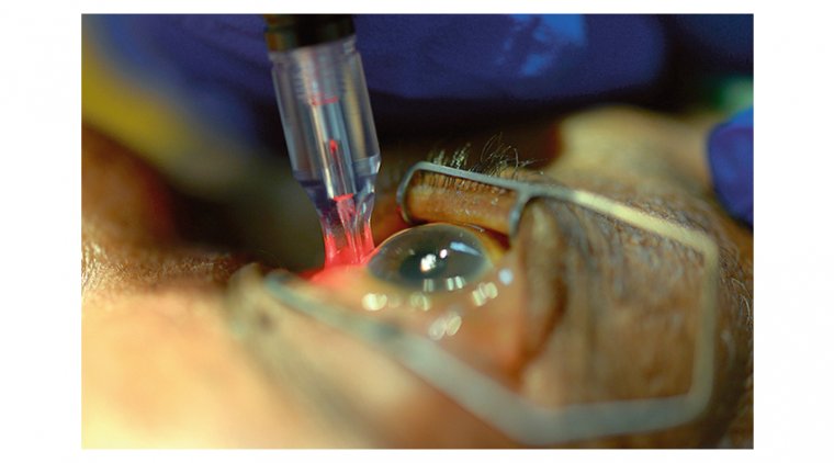 Transscleral Cyclophotocoagulation: An Alternative to Traditional Glaucoma Surgery