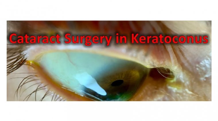 Treating Cataract Patients With Keratoconus