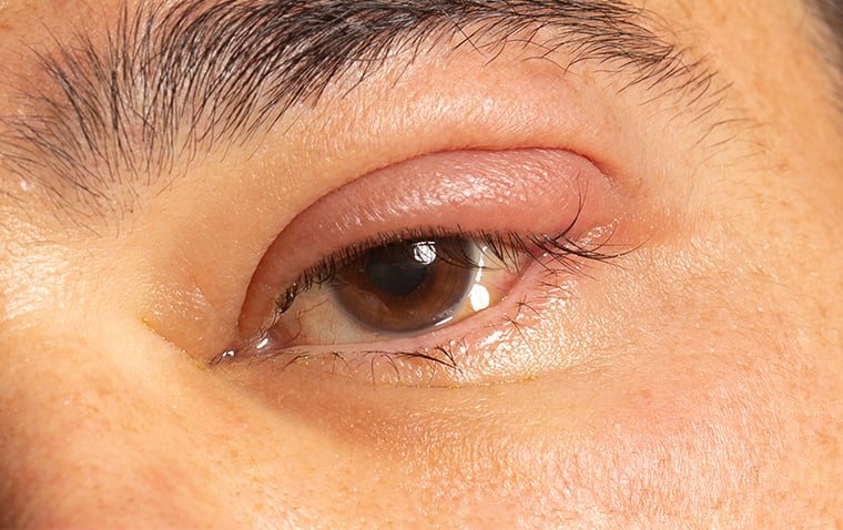 Ultimate Guide to Eyelid Hygiene: Preventing Common Eye Conditions