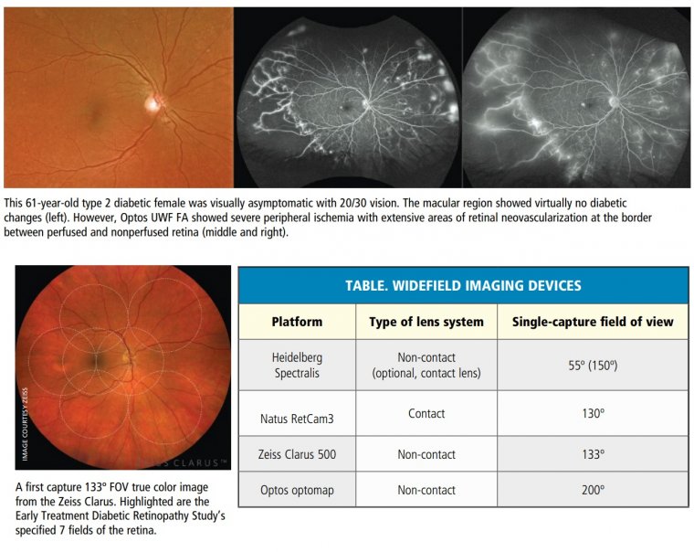 Ultra-Widefield Imaging & Managing Numerous Retinal Pathologies