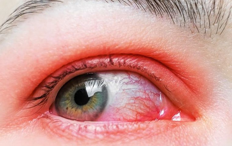 Understanding and Managing Ocular Rosacea: Symptoms & Treatment Options