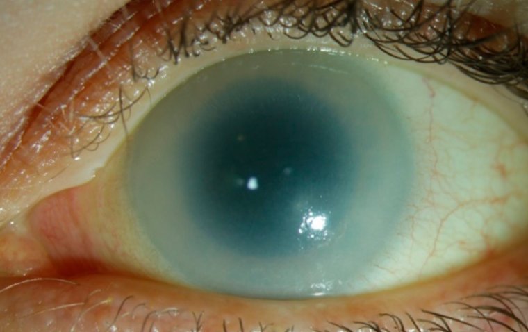 Understanding Corneal Clouding: Causes, Symptoms, and Treatment