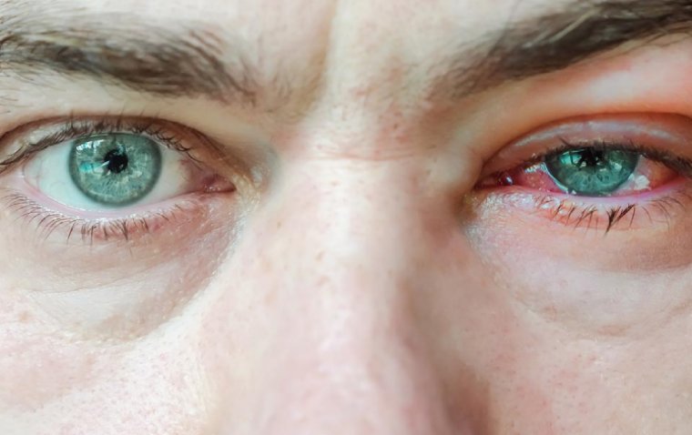 What is Chlamydia Eye Infection and How Can You Recognize It
