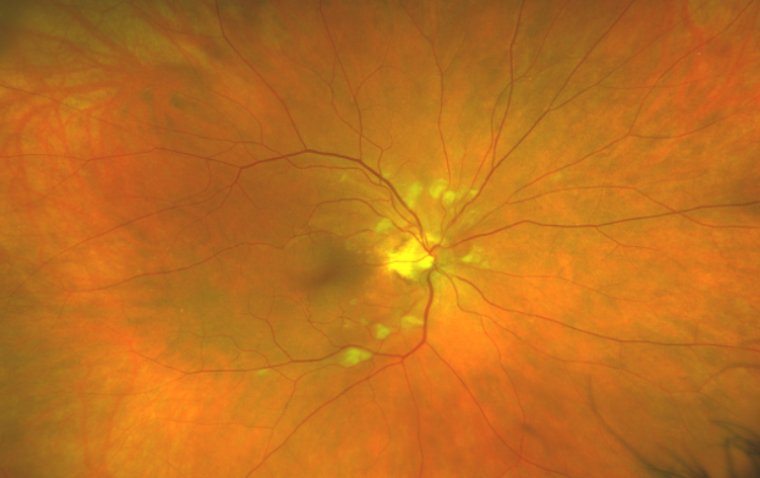 What Does It Mean to Have Cotton Wool Spots on the Retina?