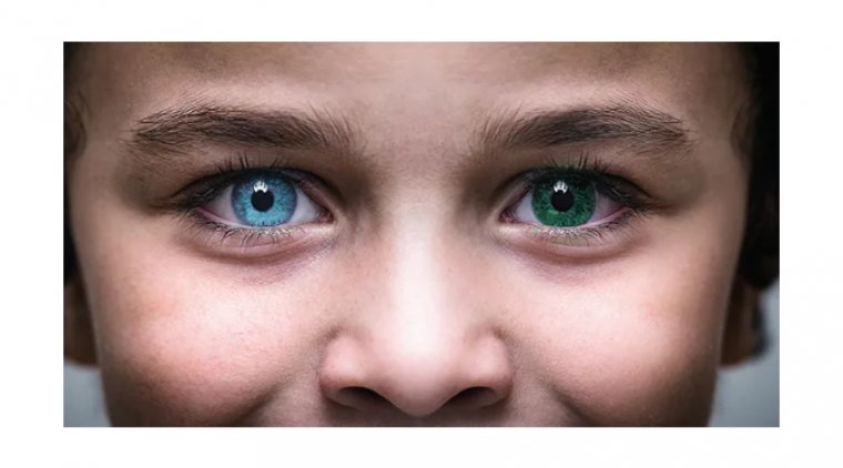 What Is Heterochromia in the Eyes and How to Deal with It? 