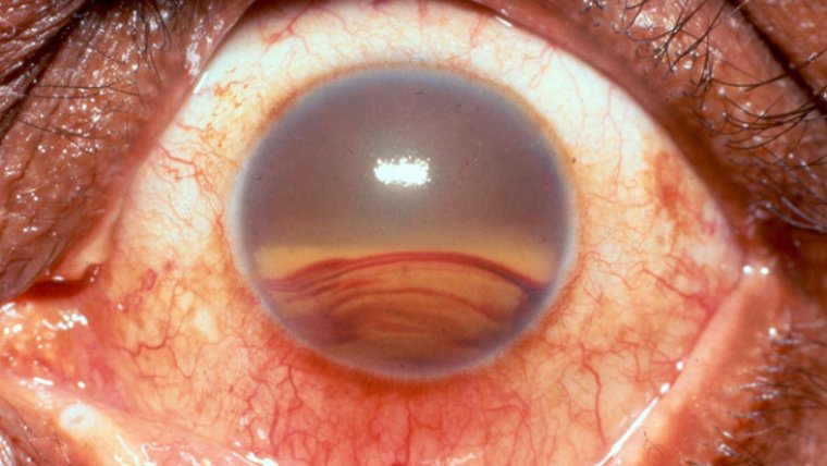 What Is Hyphema in the Eye and How to Treat It?