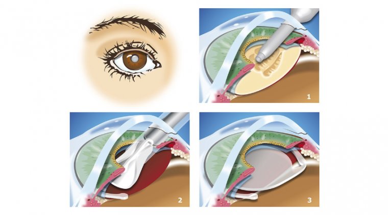 What Is Lens Replacement Surgery?