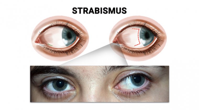 What Is Strabismus? A Comprehensive Guide for All  