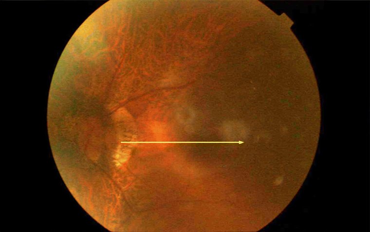 What is Suprachoroidal Hemorrhage