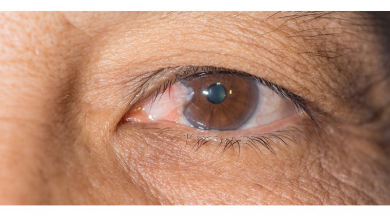 What Is Pterygium (Surfer's Eye) and How Is the Treatment Surgery? 