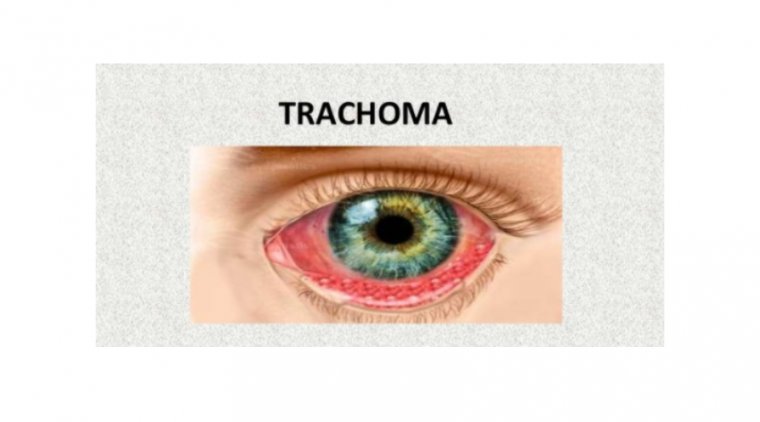 What Is Trachoma?