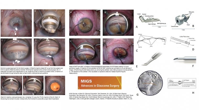 What The Future Holds For Microinvasive Glaucoma Surgeries (MIGS)