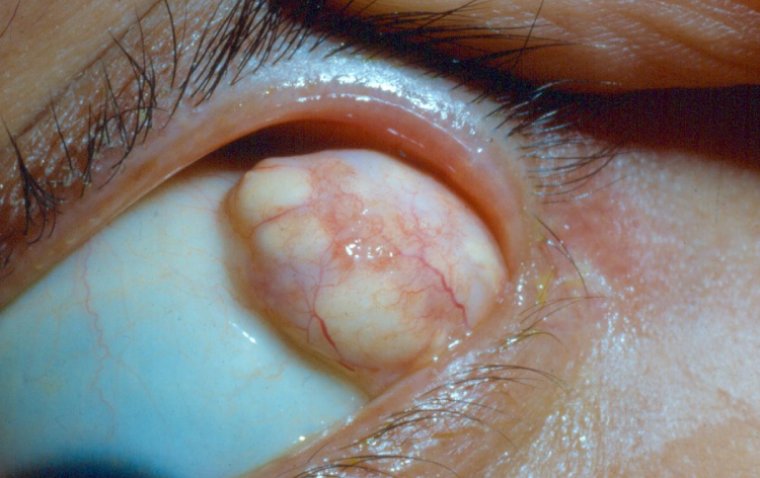 What You Need to Know About Dermoid Cyst in the Eye