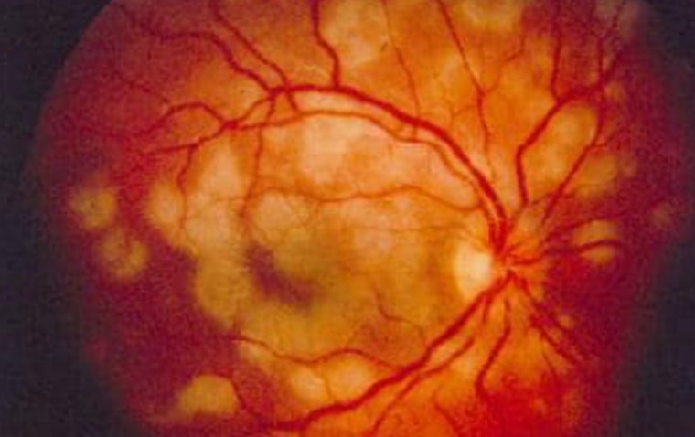 White Dot Syndrome in Focus: Types, Symptoms, and Treatment