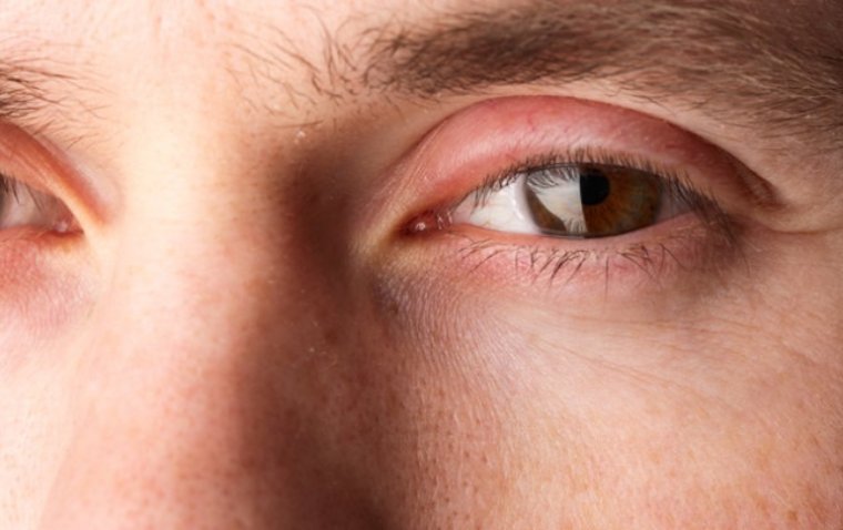 Why Is Your Upper Eyelid Swollen in the Morning?