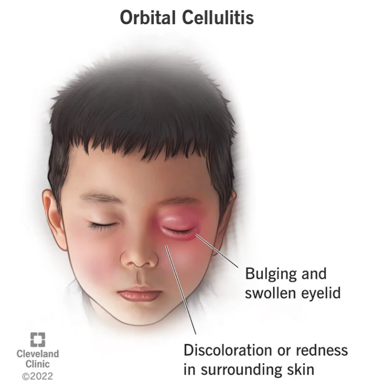 Periorbital Cellulitis Causes Symptoms And Treatment – NBKomputer