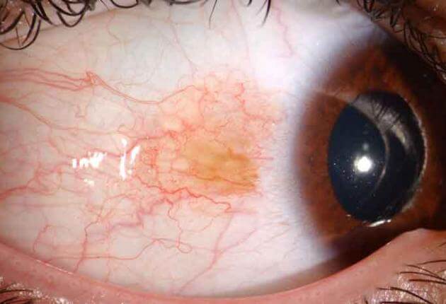 close up picture of an eye with conjunctival nevus