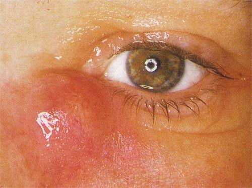 picture of an eye with Dacryocystitis