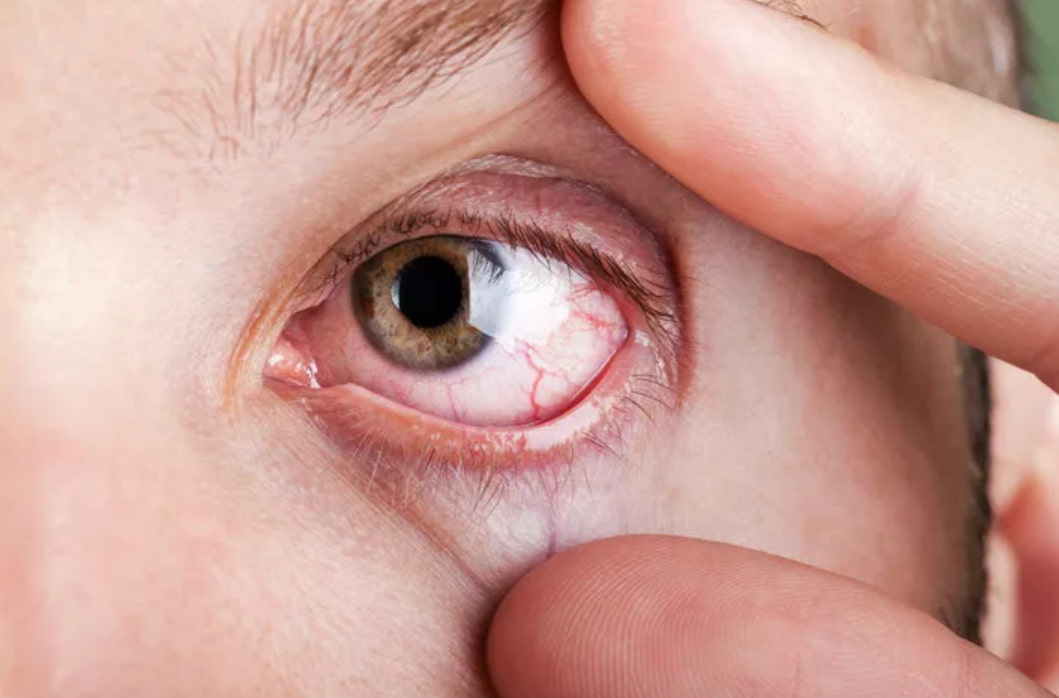closeup picture of an eye with veins