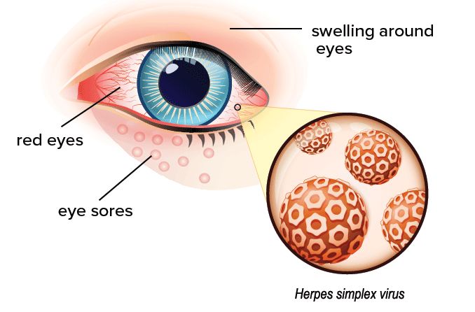 Eye Herpes Symptoms